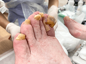 写真：高齢者の足の爪